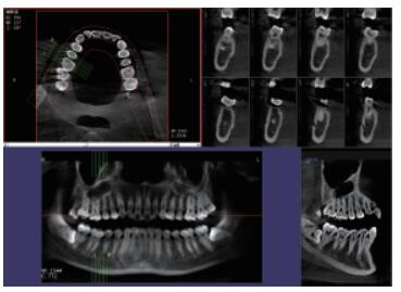 口腔CBCT三維影像