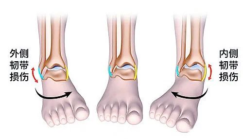 【醫療科普】之為什么說踝關節骨折手術復雜？