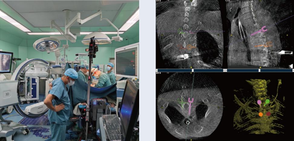 術(shù)中三維C形臂影像在脊柱導航機器人系統(tǒng)中的應用