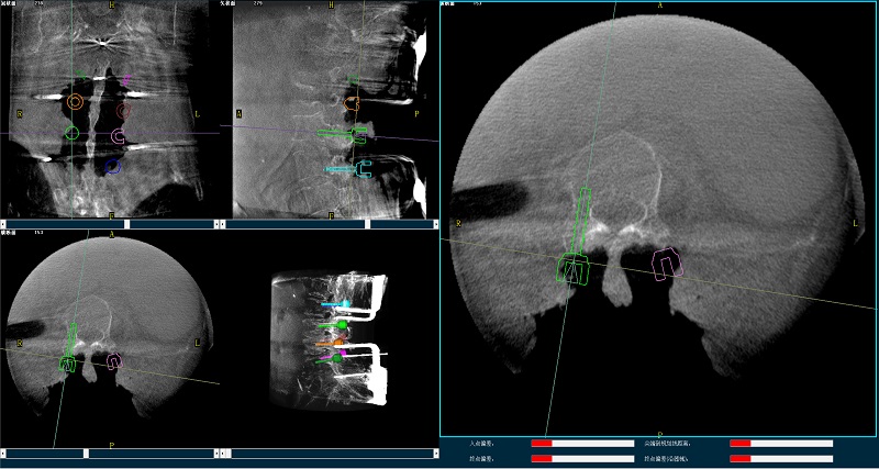 機(jī)器人輔助腰椎后路側(cè)彎矯形手術(shù)規(guī)劃圖像