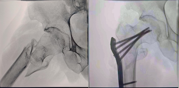 一體式移動C型臂臨床影像